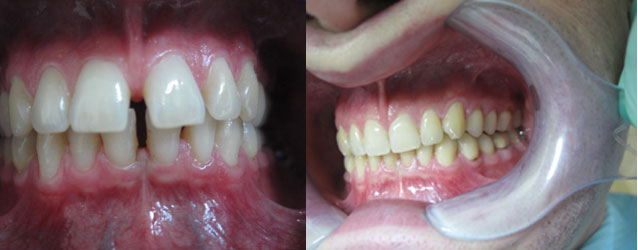 Invisalign braces deals london