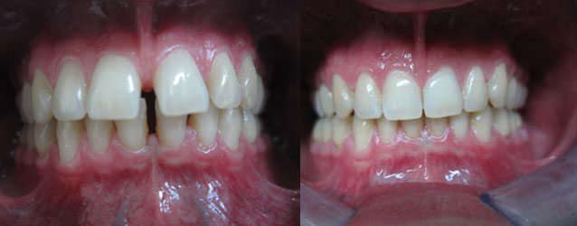 Invisalign braces deals london